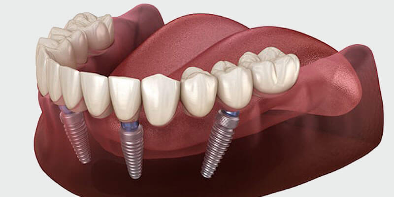 All-on-4 ist beliebtes Verfahren bei Patienten ohne Zähne