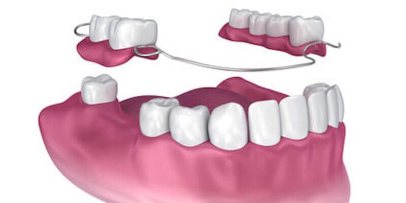 Teilprothesen schließt größere Lücken zwischen noch vorhandenen Zähnen.