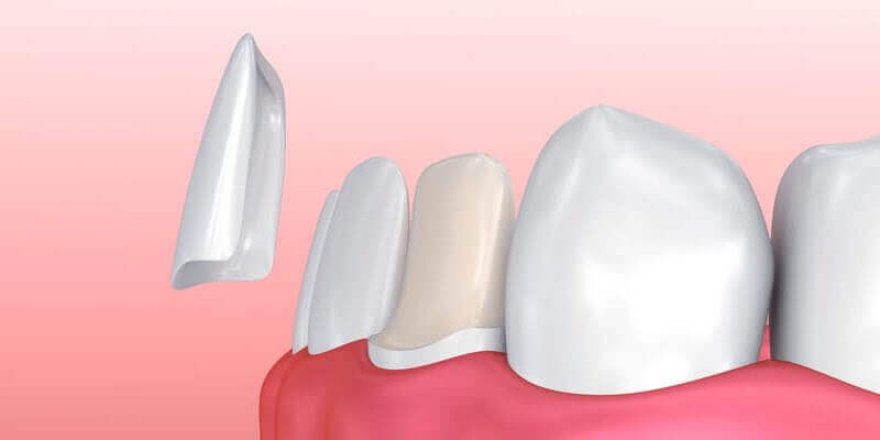 Zähne verschönern durch Veneers Zähne verschönern durch Veneers