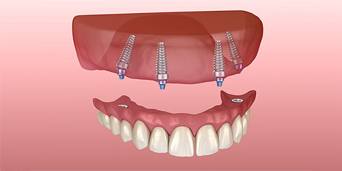 All-on-4-Behandlungskonzept als Zahnersatzvariante